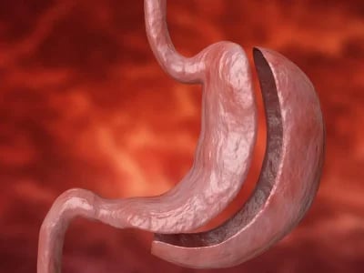 Patienten berichten über ihre positiven Erfahrungen mit Magenverkleinerung Türkei