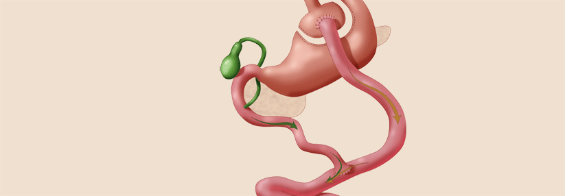 Patienten berichten über ihre positiven Erfahrungen mit Magenverkleinerung Türkei